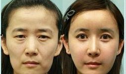 整容医院爆料案例视频,真实案例曝光，美丽背后隐藏的惊悚真相